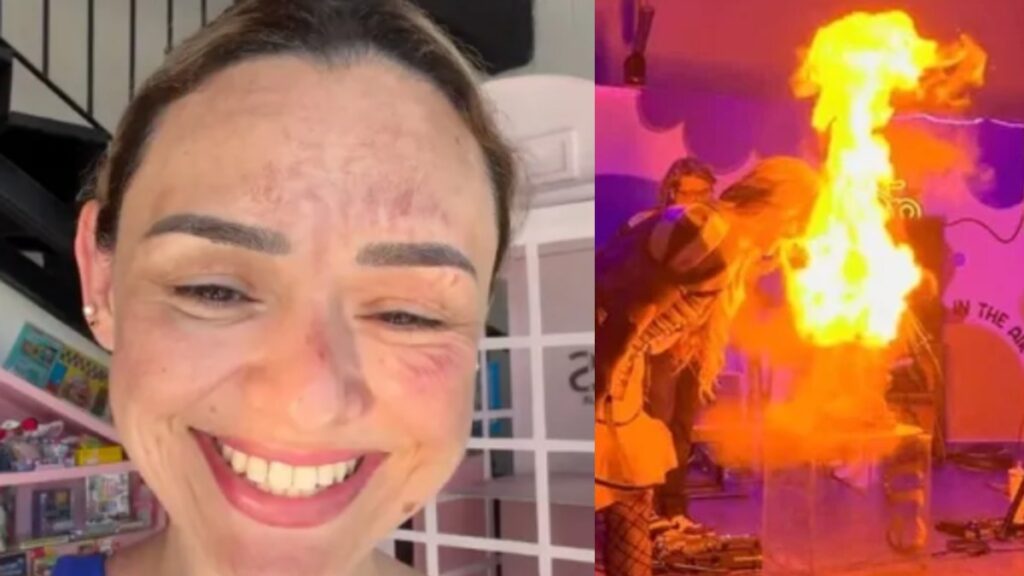 El influencer Arlen Hernández sufre quemaduras en el rostro por un ‘pastel explosivo’ en Sacramento