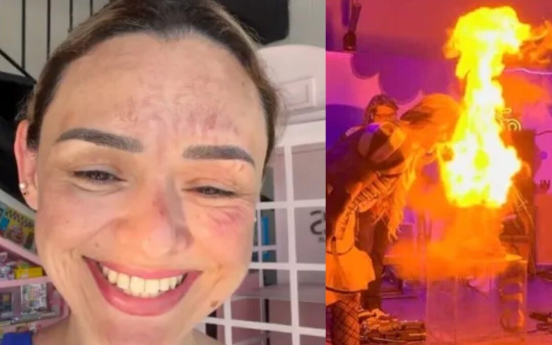 El influencer Arlen Hernández sufre quemaduras en el rostro por un ‘pastel explosivo’ en Sacramento