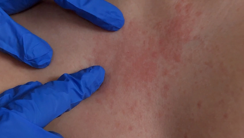 Alerta en Mexicali por Brote de Sarampión: Autoridades Informan sobre Paciente Cero